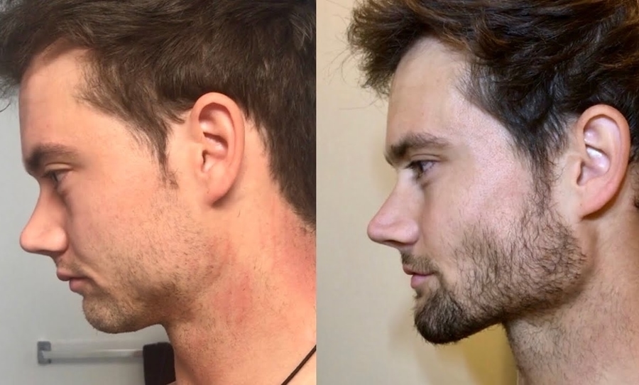 Mewing Side Profile Results - Before/Afters 