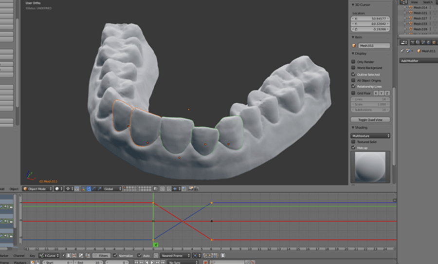 College student fixes his own teeth with $60 3D printed aligner