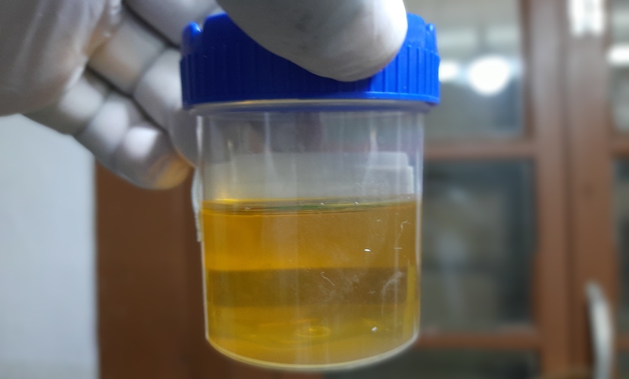 Saltourn Surgery urine sample
